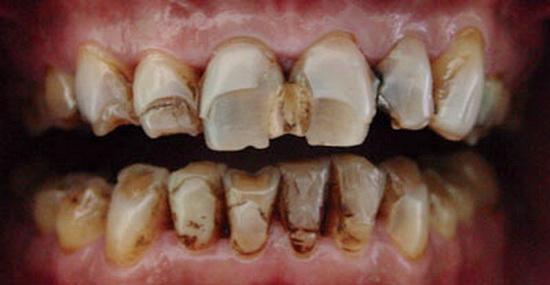 烟渍牙形成以后,虽然不会影响到正常的咀嚼,发音,但是会影响容貌美观